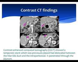 Free download 0812_revided_Wire-loop_technique_for_dislocated_stent_removal video and edit with RedcoolMedia movie maker MovieStudio video editor online and AudioStudio audio editor onlin