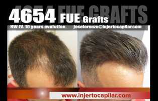 Free download 4654FUE Grafts. Long term evolution: 10 years/4 surgeries.Temporal peaks. Injertocapilar.com474/2011 video and edit with RedcoolMedia movie maker MovieStudio video editor online and AudioStudio audio editor onlin