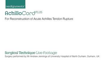 Free download AchilloCordPLUS Surgical Technique Animation video and edit with RedcoolMedia movie maker MovieStudio video editor online and AudioStudio audio editor onlin