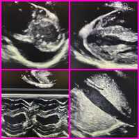Free download Pericardial Effusion .mov video and edit with RedcoolMedia movie maker MovieStudio video editor online and AudioStudio audio editor onlin