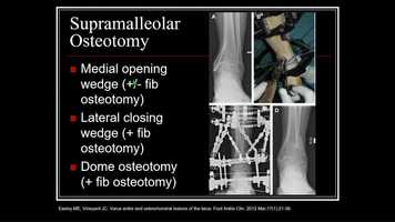 Free download THURS-Monet4-509-Evolving Technique- The Role Of Ostetomy For The Treatment Of Osteochondral Lesions Of The Talar Dome - Listen video and edit with RedcoolMedia movie maker MovieStudio video editor online and AudioStudio audio editor onlin