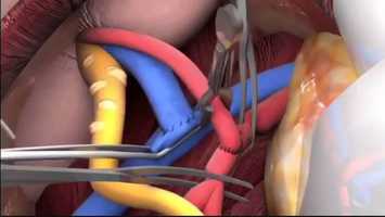 Free download trapianto intervento video and edit with RedcoolMedia movie maker MovieStudio video editor online and AudioStudio audio editor onlin