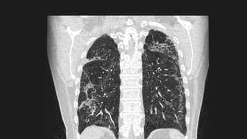 Free download Treating lung scarring, BBC News website video and edit with RedcoolMedia movie maker MovieStudio video editor online and AudioStudio audio editor onlin