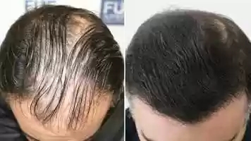 Free download 3500 Grafts FUE Hair Transplant by Dr. Juan Couto - FUEXPERT CLINIC video and edit with RedcoolMedia movie maker MovieStudio video editor online and AudioStudio audio editor onlin