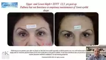 Free download 3 - Dr Paraskevas Vakis Kontoes - The Single Suture Traction Technique (SSTT) - A Prophylactic and Rejuvenating Canthopexy video and edit with RedcoolMedia movie maker MovieStudio video editor online and AudioStudio audio editor onlin