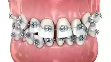 Free download Braces video and edit with RedcoolMedia movie maker MovieStudio video editor online and AudioStudio audio editor onlin