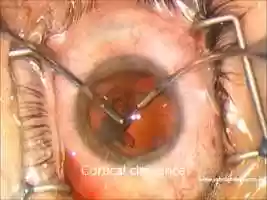 Free download Cataract Surgery video and edit with RedcoolMedia movie maker MovieStudio video editor online and AudioStudio audio editor onlin