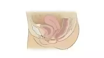 Free download Cystocele AI Animation v1 video and edit with RedcoolMedia movie maker MovieStudio video editor online and AudioStudio audio editor onlin