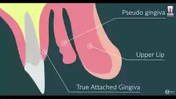 Free download double gingiva dental surgery animation عملية للاسنان فيديو انيمشن video and edit with RedcoolMedia movie maker MovieStudio video editor online and AudioStudio audio editor onlin