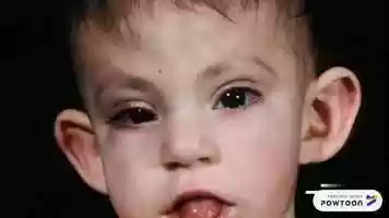 Free download Fetal Alcohol SYndrome video and edit with RedcoolMedia movie maker MovieStudio video editor online and AudioStudio audio editor onlin
