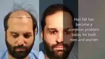 Free download Hair Transplant in Chandigarh.mp4 video and edit with RedcoolMedia movie maker MovieStudio video editor online and AudioStudio audio editor onlin