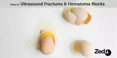 Free download How to: Ultrasound fractures and hematoma blocks video and edit with RedcoolMedia movie maker MovieStudio video editor online and AudioStudio audio editor onlin