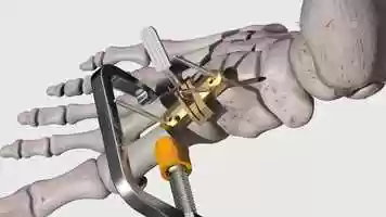 Free download Lapiplasty Surgical Technique Animation video and edit with RedcoolMedia movie maker MovieStudio video editor online and AudioStudio audio editor onlin