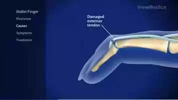 Free download Mallet Finger Animation video and edit with RedcoolMedia movie maker MovieStudio video editor online and AudioStudio audio editor onlin