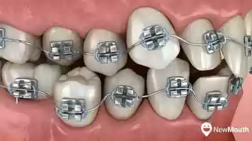 Free download Metal Braces NewMouth video and edit with RedcoolMedia movie maker MovieStudio video editor online and AudioStudio audio editor onlin