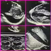 Free download Pericardial Effusion .mov video and edit with RedcoolMedia movie maker MovieStudio video editor online and AudioStudio audio editor onlin