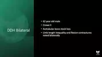Free download Revisiting the Autologous Graft for Acetabular Defects with Anterior Approach video and edit with RedcoolMedia movie maker MovieStudio video editor online and AudioStudio audio editor onlin
