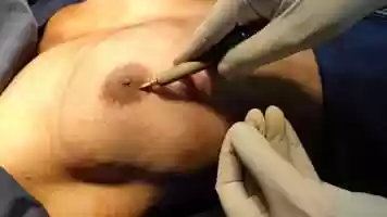 Free download VASER Skin Protection Port to prevent burn injury.mp4 video and edit with RedcoolMedia movie maker MovieStudio video editor online and AudioStudio audio editor onlin