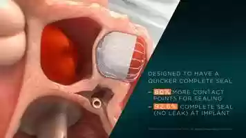 Free download WATCHMAN FLX Animation - Implant Technique video and edit with RedcoolMedia movie maker MovieStudio video editor online and AudioStudio audio editor onlin