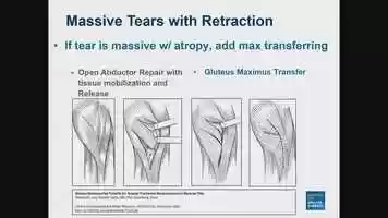 Free download WED-GRAND3-112 - Evolving Technique Update- Psoas Tendinitis After Total Hip Arthroplasty - Revision Scott Sporer, MD video and edit with RedcoolMedia movie maker MovieStudio video editor online and AudioStudio audio editor onlin