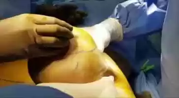 Free download Wise Pattern Breast Reduction Surgery by Dr. Ajaya Kashyap video and edit with RedcoolMedia movie maker MovieStudio video editor online and AudioStudio audio editor onlin